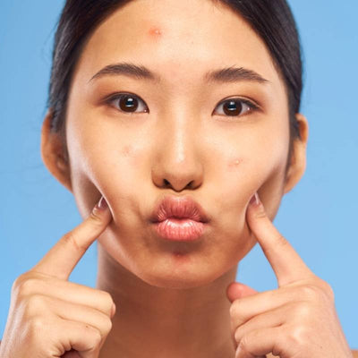 Tipi di brufoli sul viso (mento, fronte e guance): cause e cure